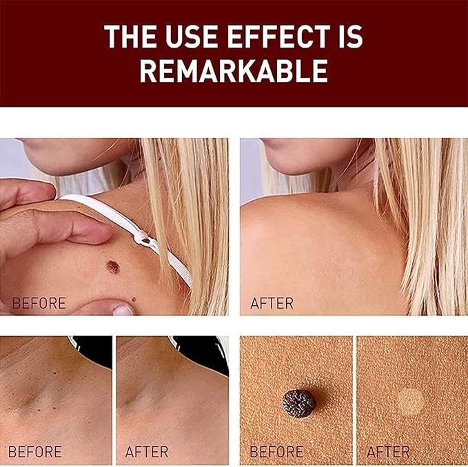 Tag & Mole Remover Pen